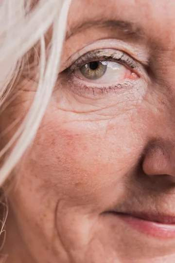 Imagem ilustrativa de blefaroplastia